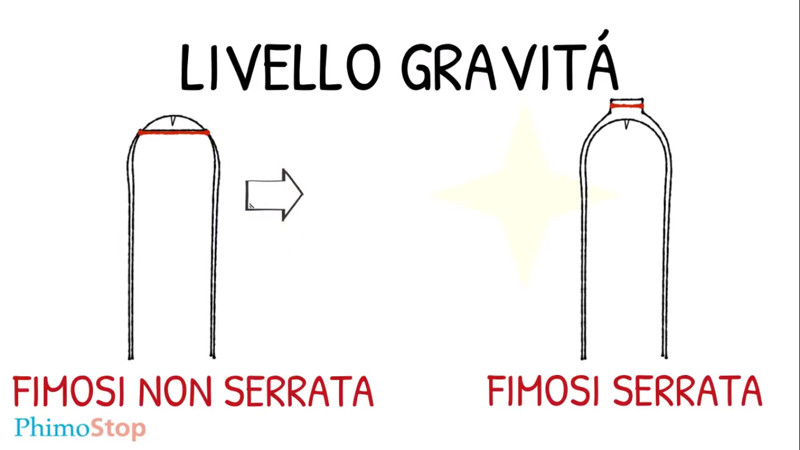 differenze tra fimosi serrata e fimosi non serrata